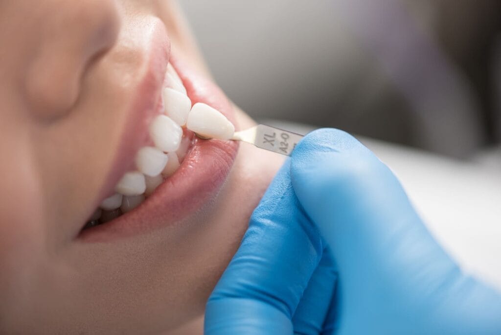 Come cambiano i denti con le faccette dentali 2 faccette dentali