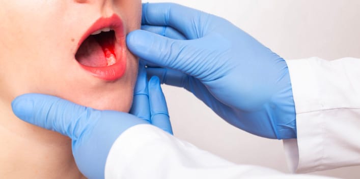 Parodontologia 4 Parodontologia | Trattamenti dello Studio dentistico Foli | Dentista a Genova | Cura della parodontite a Genova
