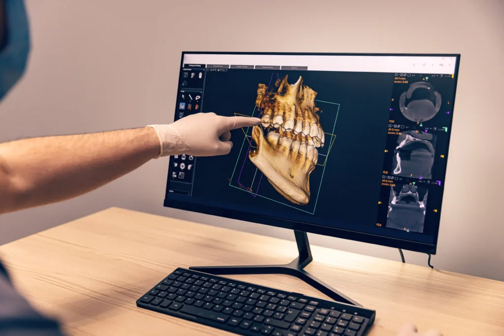 Implantologia computer guidata: come funziona e quali vantaggi offre al paziente 1 Implantologia computer guidata