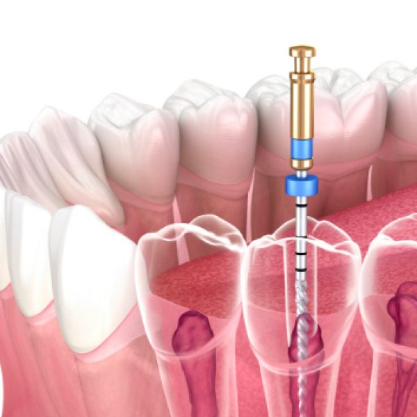 Endodonzia | Trattamenti dello Studio dentistico Foli | Dentista a Genova
