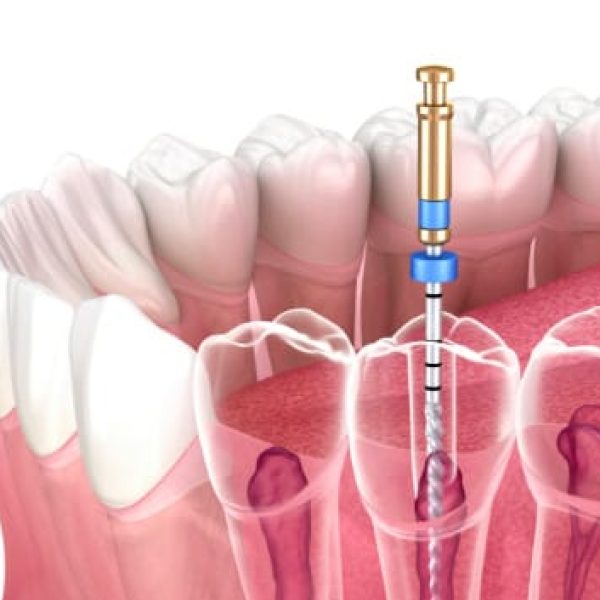 Endodonzia | Trattamenti dello Studio dentistico Foli | Dentista a Genova Endodonzia | Trattamenti dello Studio dentistico Foli | Dentista a Genova