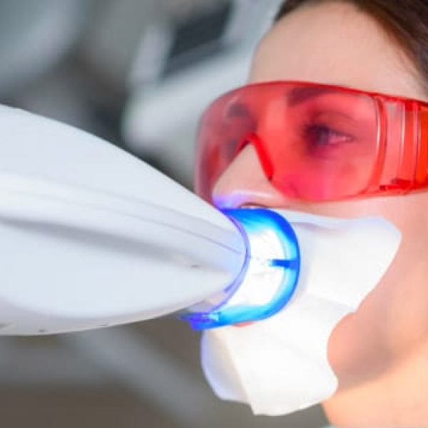 Sbiancamento | Trattamenti dello Studio dentistico Foli | Dentista a Genova Sbiancamento | Trattamenti dello Studio dentistico Foli | Dentista a Genova