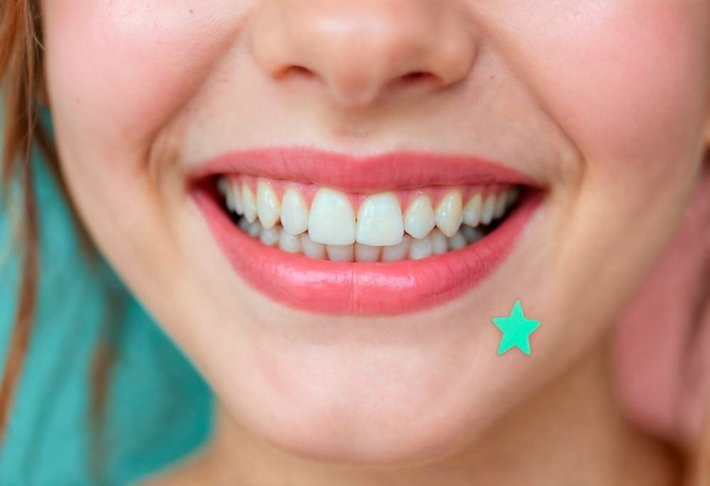Rimozione delle faccette dentali: come funziona la procedura e come si sostituiscono 1 rimozione delle faccette dentali